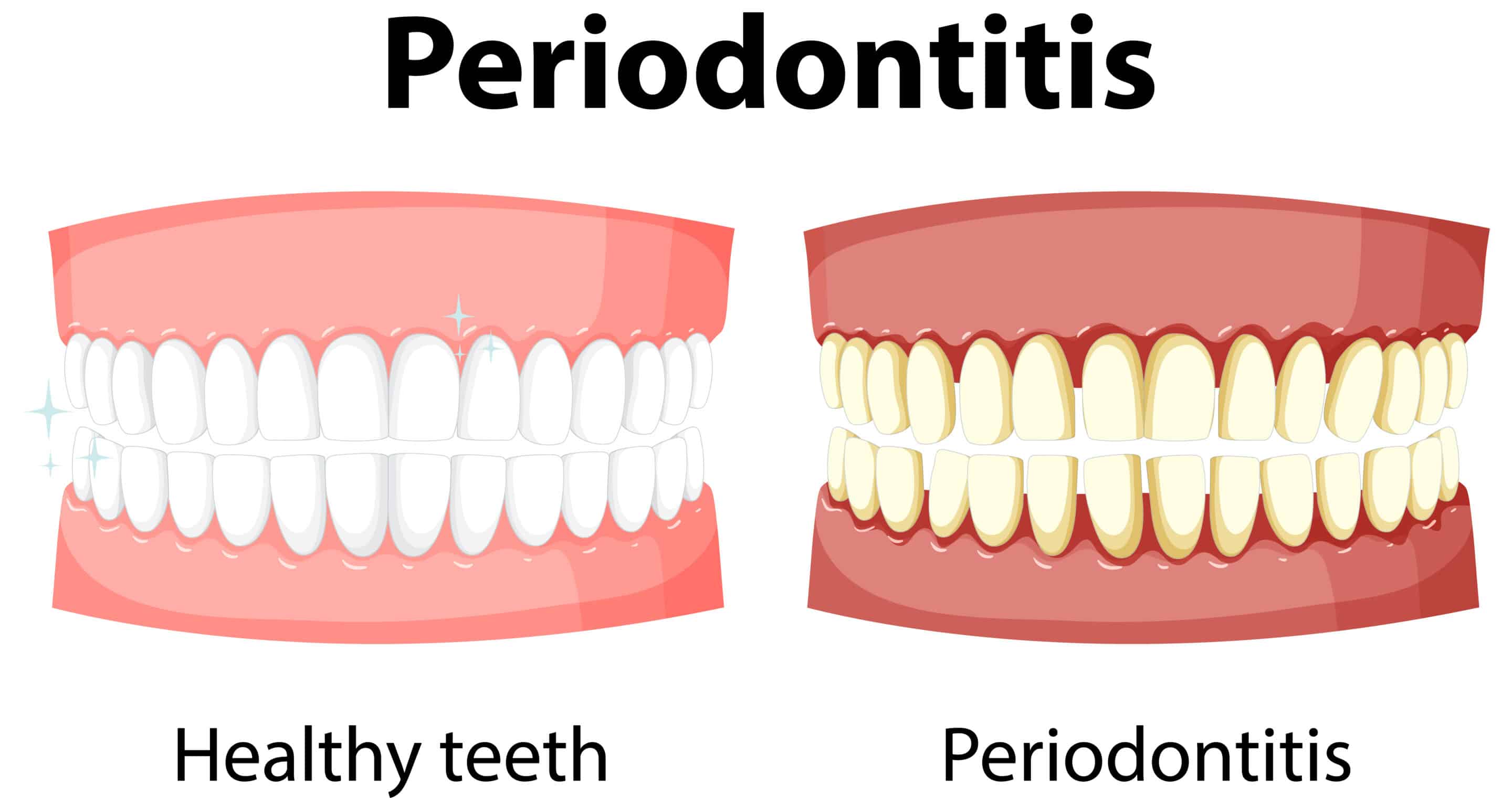 Healing Gum Diseases Naturally Scaling And Root Planing As A Holistic Treatment