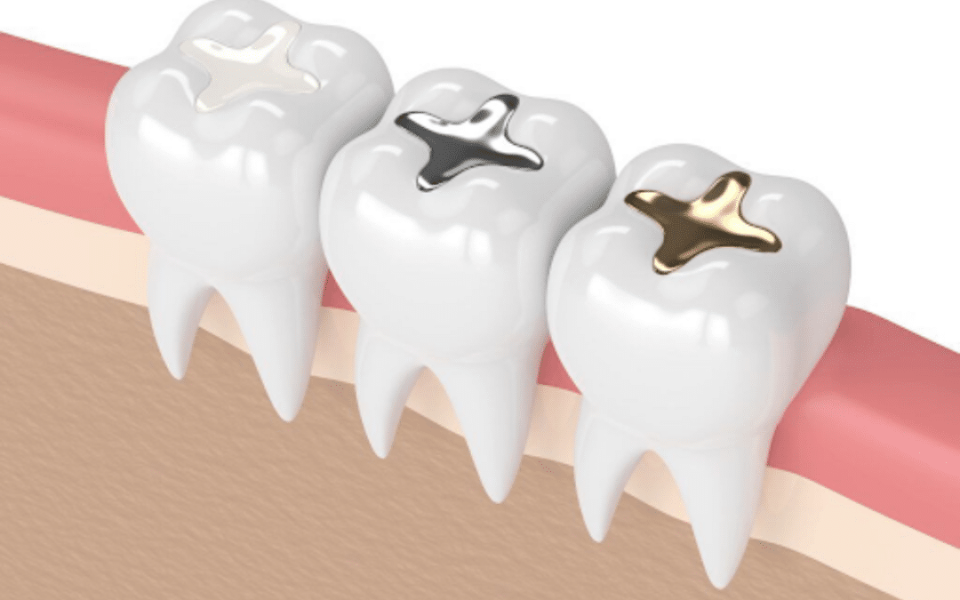 Why Should You Consider Replacing Metal Fillings? 6 Compelling Reasons