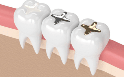 Why Should You Consider Replacing Metal Fillings? 6 Compelling Reasons