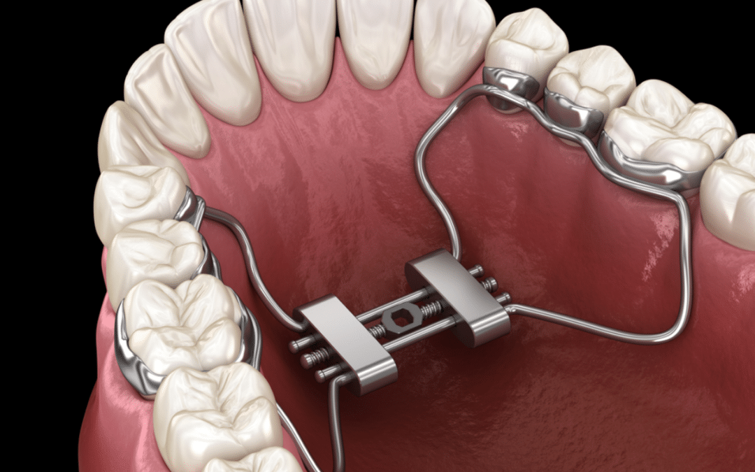 How Airway Expansion Appliances are Revolutionizing Sleep in 2024?