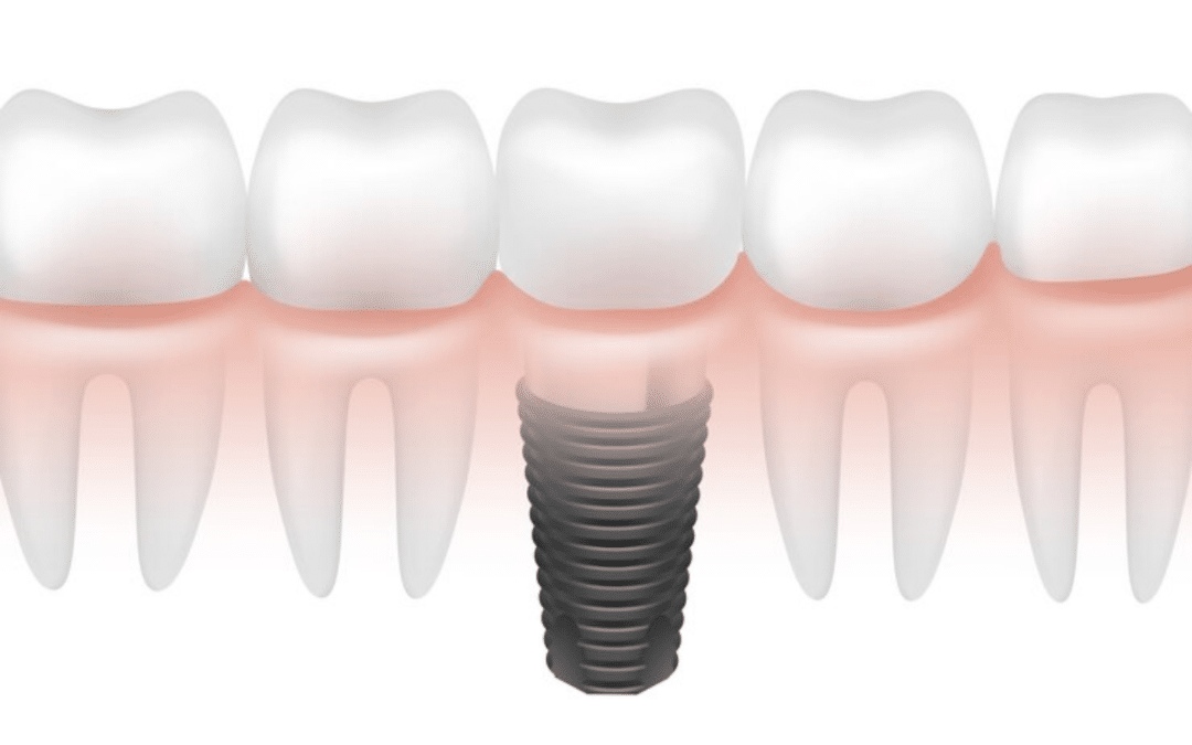 are zirconia implants safe