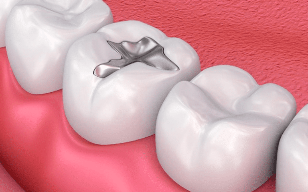 mercury fillings in your teeth