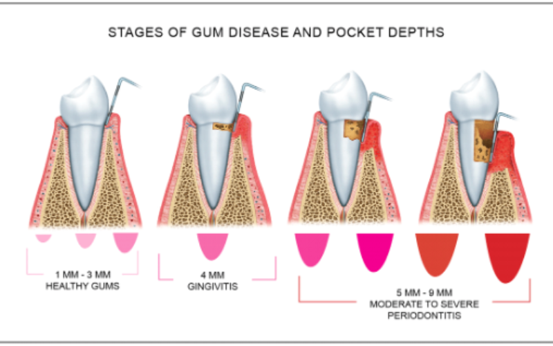 How Dentists Measure Gums to Detect Disease?