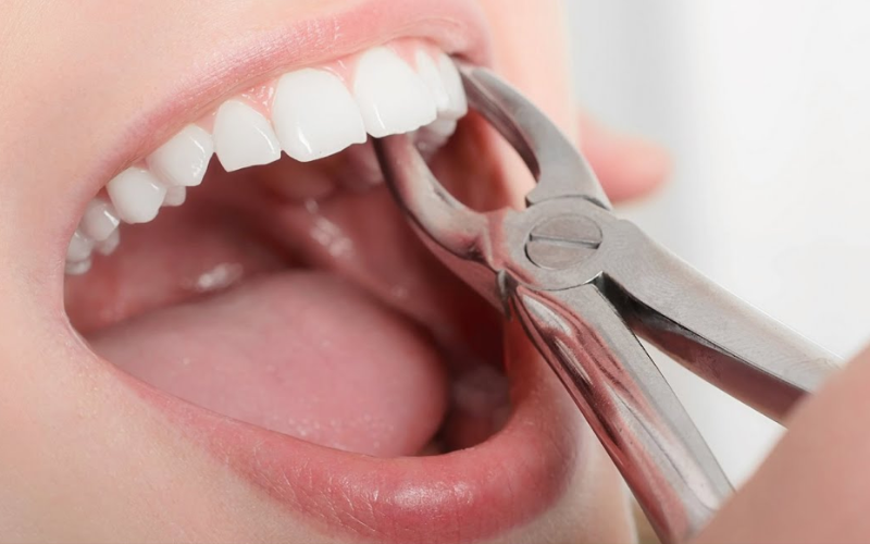 Benefits of biological tooth extraction