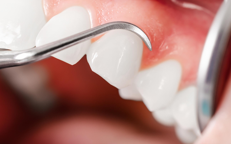 Aftercare Tips for Successful Gum Therapy Recovery