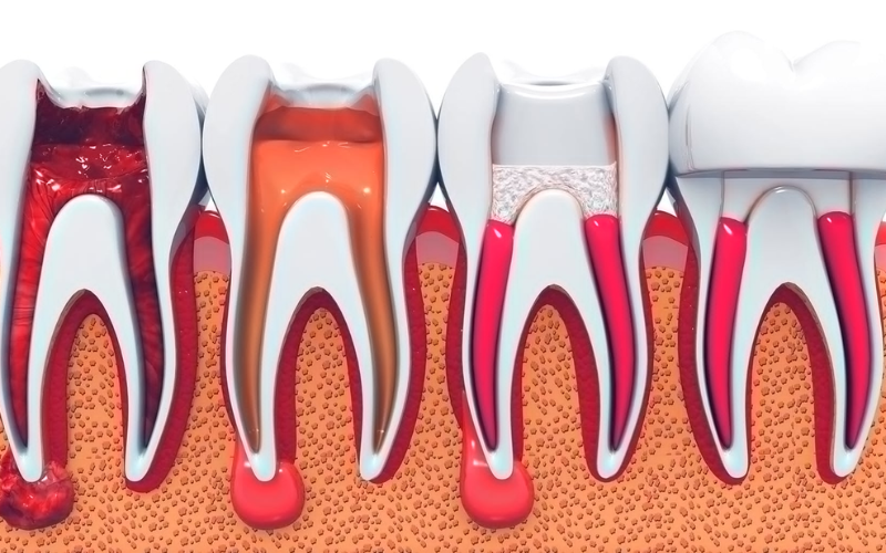 Alternatives for root canals