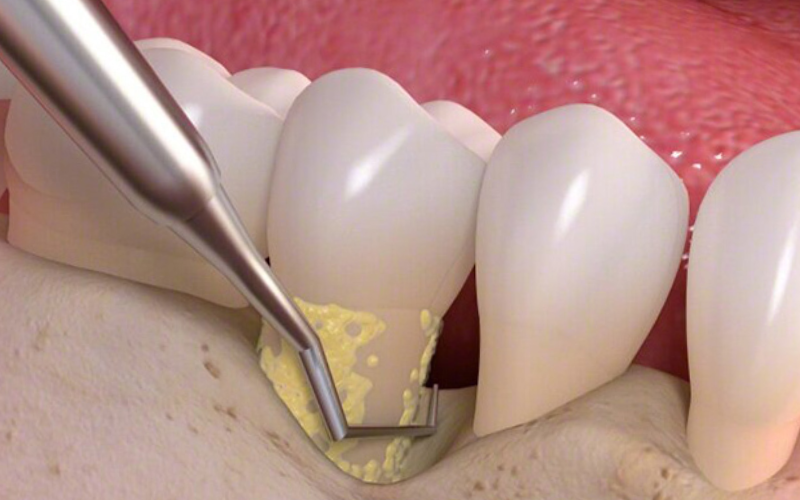 Scaling & Root Planing To Treat Gum Disease