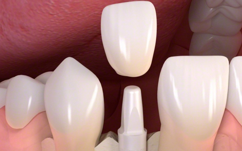 everything about zirconia implants